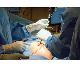 Боли после резекции яичников